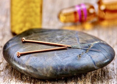 Акупунктура