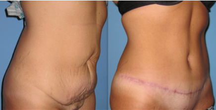 Как да стегнем кожата след отслабване?