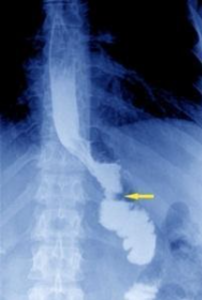 Затлъстяването при възрастните и хормоналния дисбаланс – как да се справим?